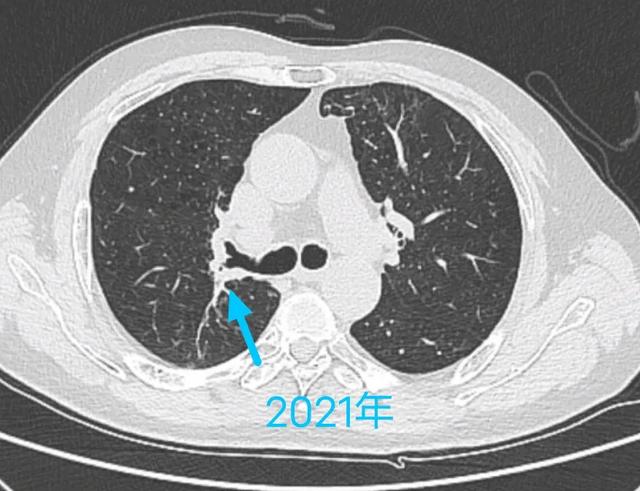 癌症从一开始就已经决定一个人的命运，治和不治都一样，是真的吗？插图5