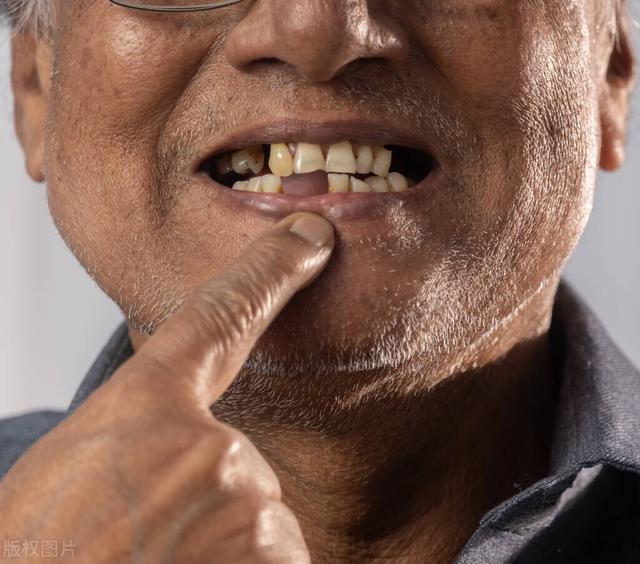 do-people-lose-their-teeth-when-they-get-old-tooth-loss-in-old-age-is