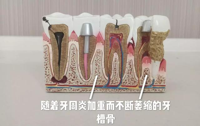 洗牙之前必须吃早餐吗:洗牙之前必须吃早饭吗 洗牙的过程是什么样的，洗完之后感觉如何？