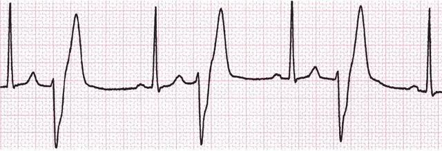 室早二联律和三联律严重吗?-我的快乐小窝
