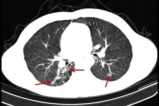 肺纤维化病灶图片