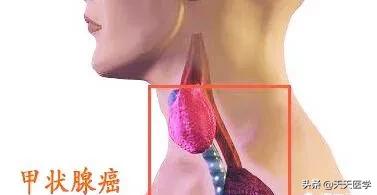 头条问答 甲状腺癌有淋巴转移一定要做碘 131治疗吗 5个回答