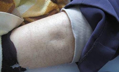 怎样区分肾病水肿?-育儿网