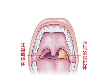 儿童喉咙正常图片图片