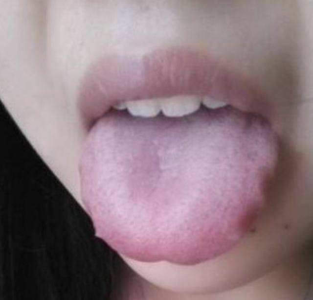舌头胖大有齿痕，需要怎么调理？插图7
