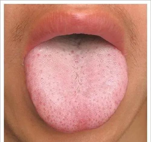 舌头胖大有齿痕，需要怎么调理？插图