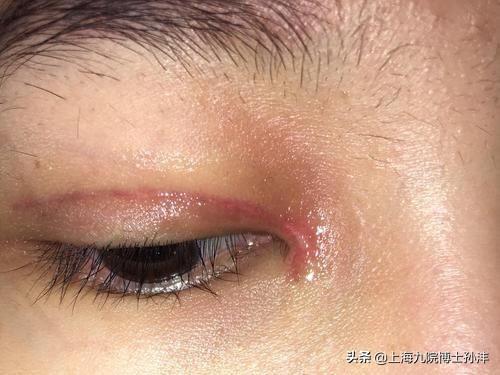 双眼皮内眼角拆线多少钱:做完切开双眼皮＋开内眼角拆线后有必要搽一些抗疤痕的药吗？