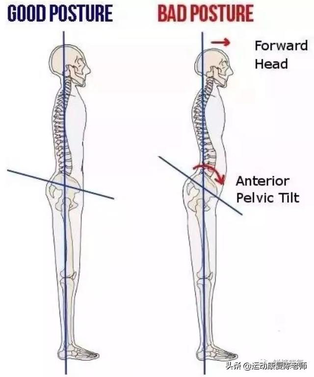 颈部牵引能使膨出恢复吗:颈椎前突锻炼方法有哪些？