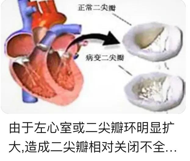 高血压心脏病的症状:血压高是否会影响心脏问题？