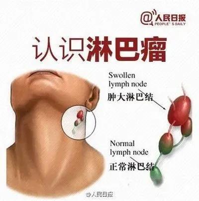 不影响寿命的十大癌症:现如今哪些癌症能被临床治愈，或者5年存活率高？