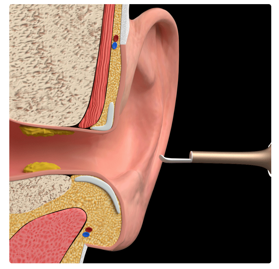 采耳会对耳朵有影响吗，自己掏耳朵会导致中耳炎吗患者日常如何护理
