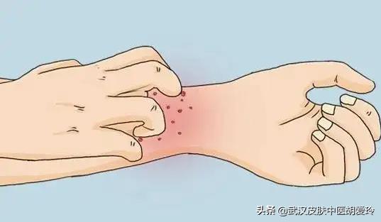 What causes itching in the elderly - iMedia