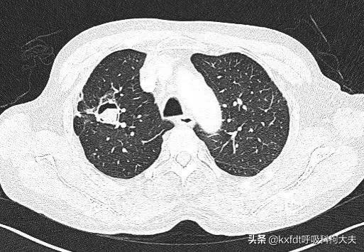 肺部真菌感染:常年肺部感染、吐黄痰、抗菌素效果不佳到底该不该切肺？