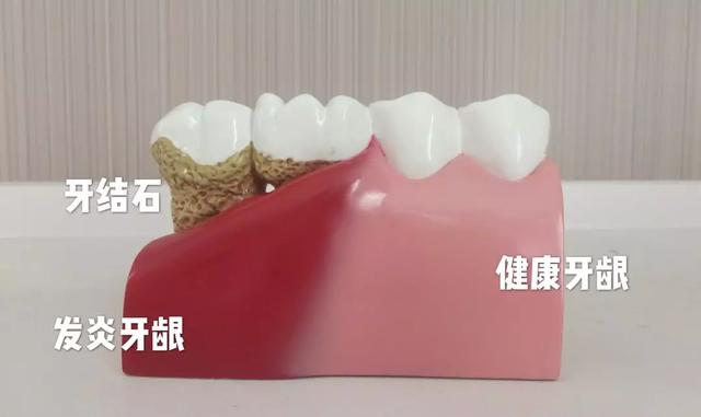 洗牙之前必须吃早餐吗:洗牙之前必须吃早饭吗 洗牙的过程是什么样的，洗完之后感觉如何？