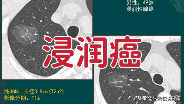 头条问答 癌细胞浸润是什么意思 33个回答
