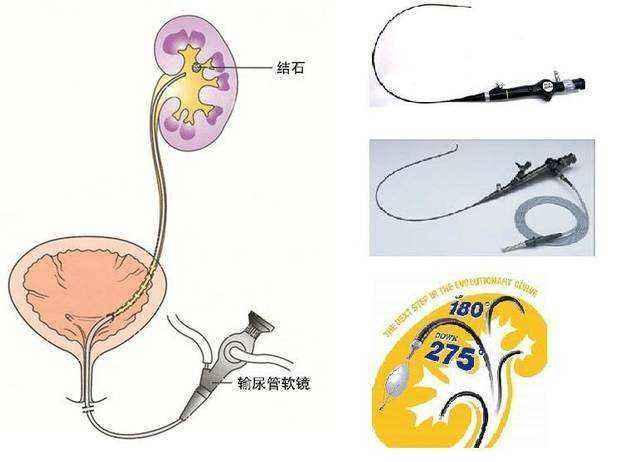 则可通过留置尿管或膀胱造瘘术引流尿液,待肾功能恢复,病情允许的情况