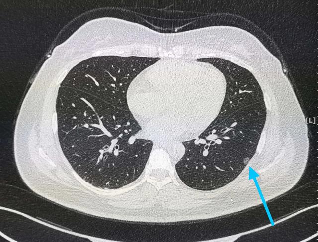 肺原位癌能活30年吗