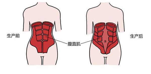 什么是腹直肌分离