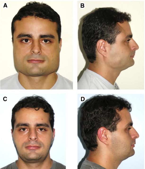 吃槟榔,腮帮子咬肌都练起来了,把脸型都嚼变形了,要怎么样才能恢复?