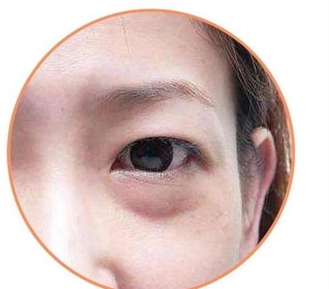 假性眼袋需要怎样去除呢?手术就算了?-头条问答
