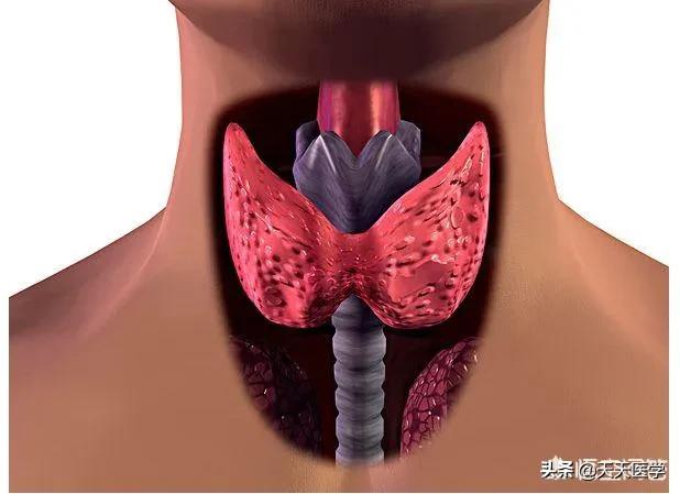 头条问答 甲状腺癌有淋巴转移一定要做碘 131治疗吗 天天医学的回答 0赞