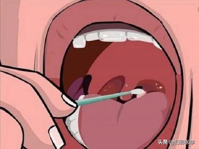 扁桃体结石能用棉签挤出来吗