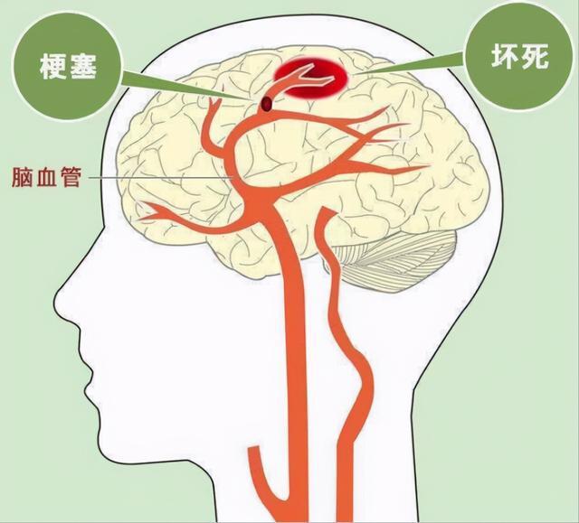 脑供血不足会怎样?-惠修网