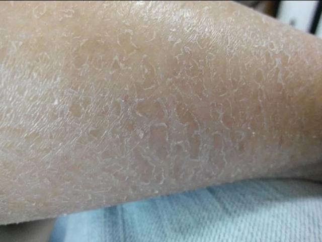 为什么有人一到冬天腿上长干皮屑,裤子上有白渣渣.怎么缓解?-生活百科