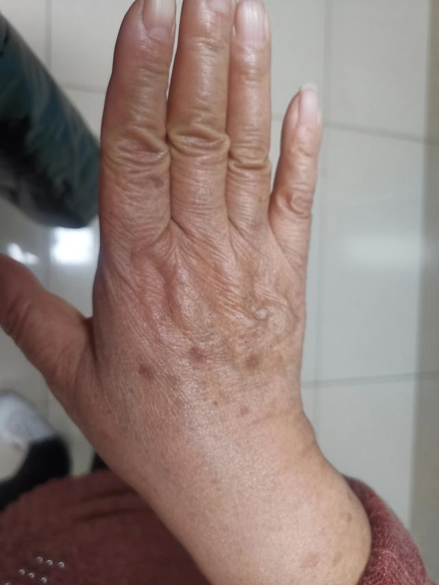 请问你们什么时候发现手上开始长老年斑的