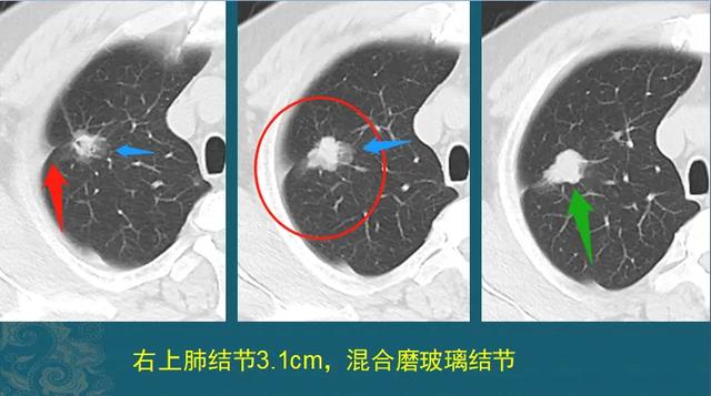 癌症从一开始就已经决定一个人的命运，治和不治都一样，是真的吗？插图1