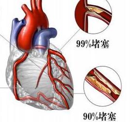 得了冠心病能出去旅游吗？插图15