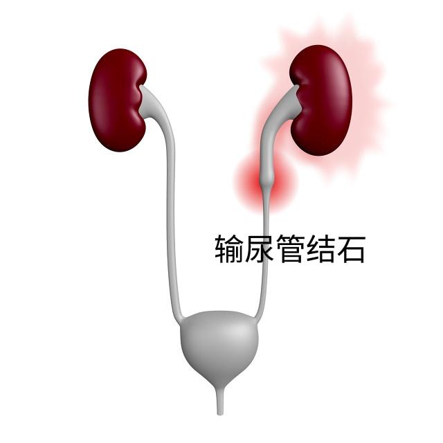 尿结石的治疗方法:尿结石能不能排出来呢？有哪些排出来的方法呢？