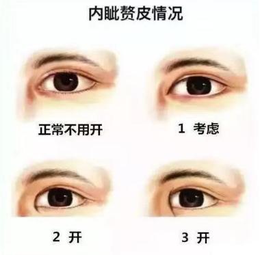 头条问答 - 开眼角危险吗?需要注意哪些事项?(9个回答)