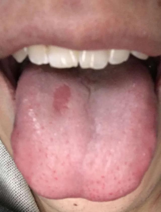 小孩舌头裂开的图片图片