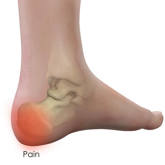 足底筋膜炎有什么征兆，足底筋膜炎有什么好的治疗方法吗