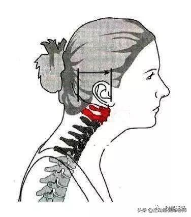 颈部牵引能使膨出恢复吗:颈椎前突锻炼方法有哪些？