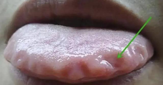 舌头胖大有齿痕，需要怎么调理？插图6