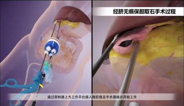 上海新科结石病医院保胆取石:胆囊结石真的只有无胆选择吗？