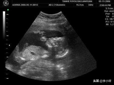 第二胎胎停人流后，多久可以怀孕？需要注意些什么？